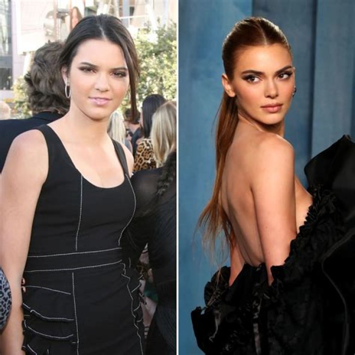 Kendall Jenner Has Long Been the Subject of Plastic Surgery Rumors — But Has She Gone Under the Knife?