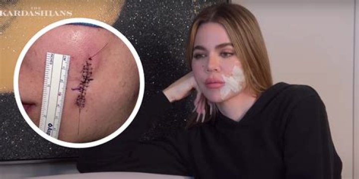 Khloé Kardashian’s Skin Cancer Scare Still Serves as a Warning to Fans — “I Had 8 Inches of Skin Removed”